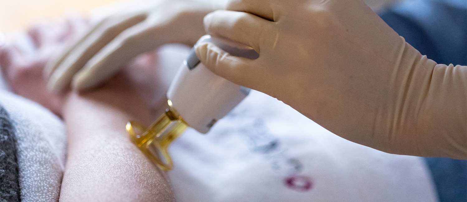Depilação Laser Alexandrite